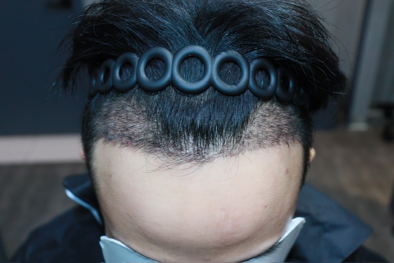 광주 압구정모비앙 모발이식수술 2주 경과 후기