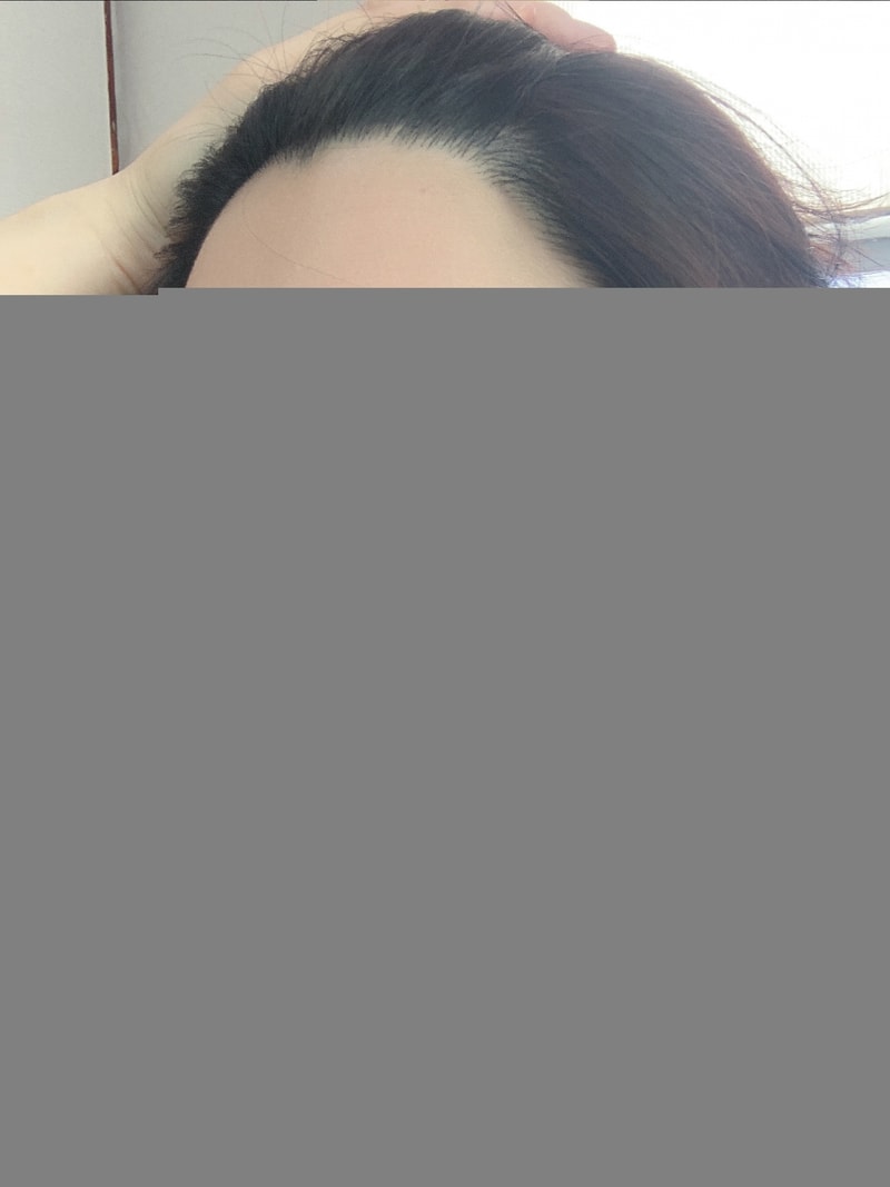 New Hairline Hair Transplantation in Year 1❤️