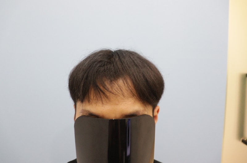 광주압구정 모비앙의원 모발이식 1년경과후기
