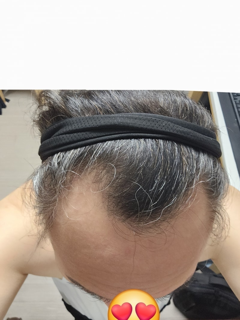 수술 3개월째