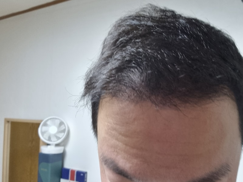모재성 2000모낭 120일차