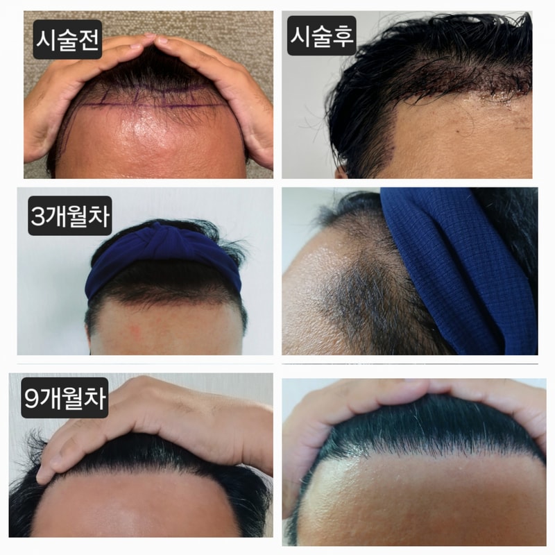 뉴헤어, 모발이식 1700모낭 9개월차 후기