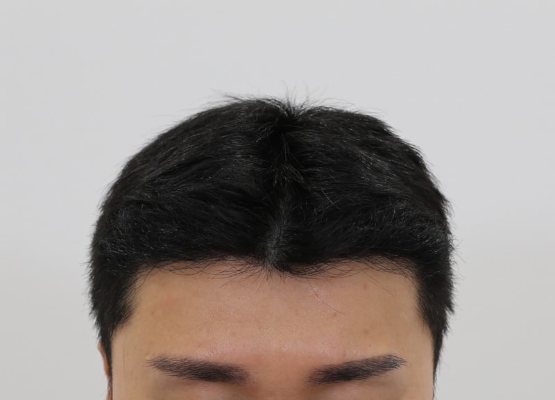 압구정 맘모스 M자 모발이식 10개월 최종경과 다녀왔습니다. (비절개 1363모낭)