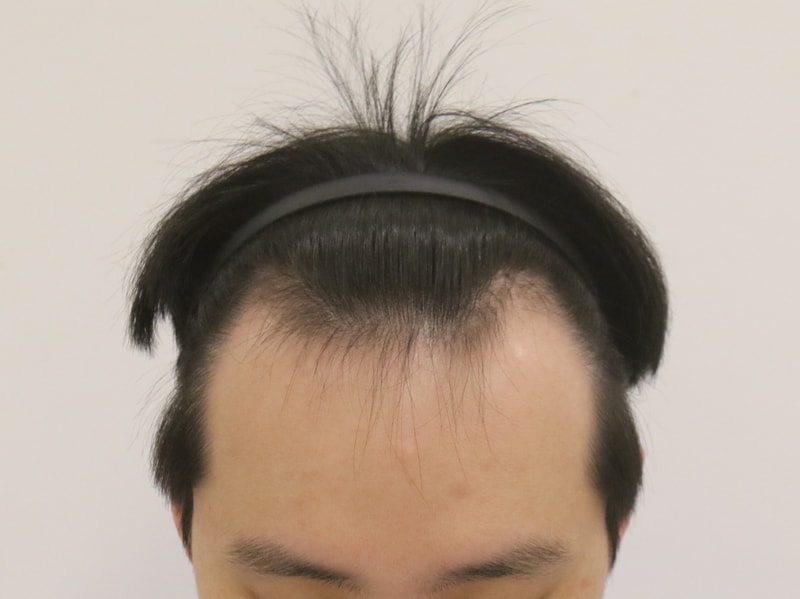 부산맘모스 모발이식 4개월 경과 후기