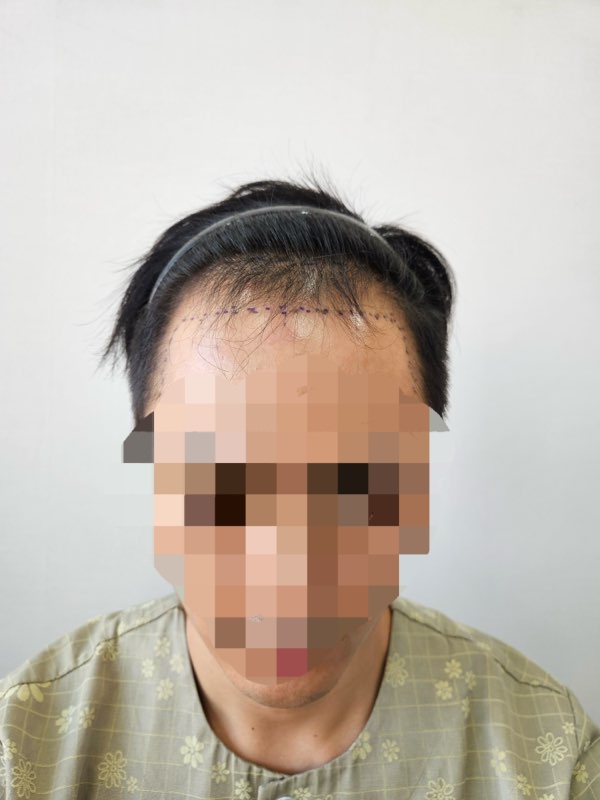M-shaped hair loss 1,800 hair follicle non-excision surgery review