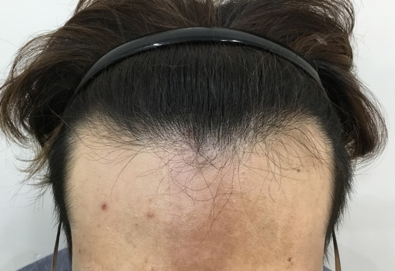 2주경과 사진 후기입니다
