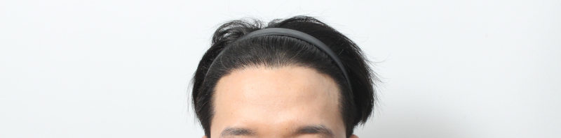 モアート医院4ヶ月目 体験談(M字。無削髪非切開)