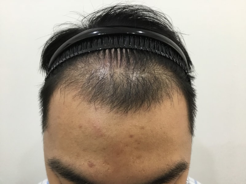 이식 5일차 후기
