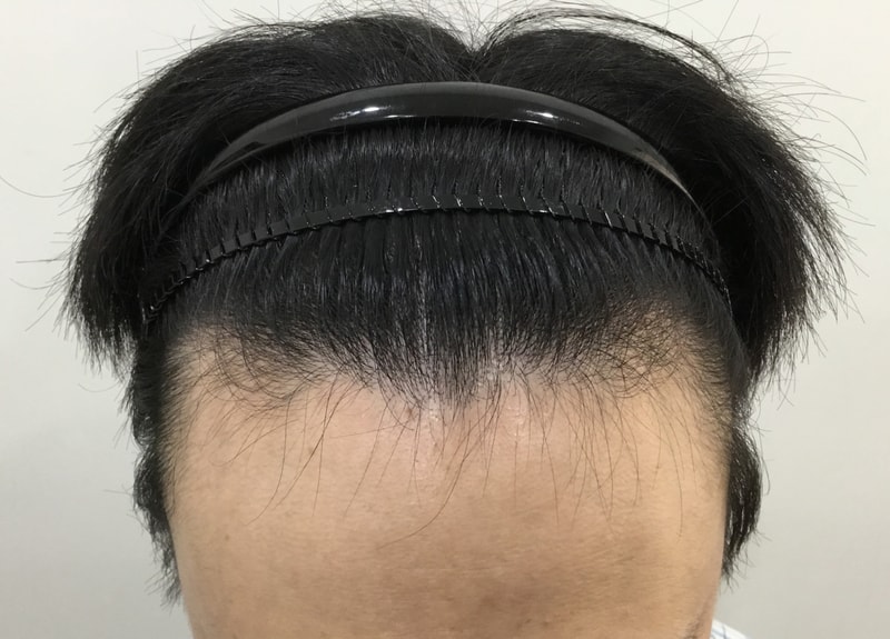 이식 2주차 기록