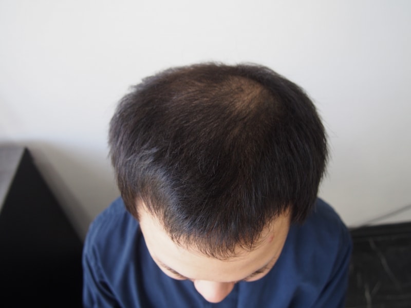 4월 18일날 수술헸습니다.