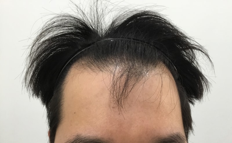 모발이식 9개월째