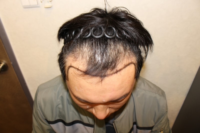 4-17-790321오승협__수술전 (5).JPG