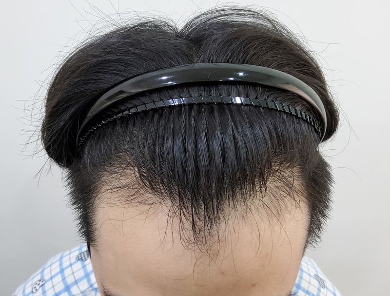 비절개 M자 3300모 3일차