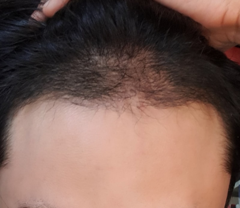 수술후128일인데 밀도가 더 올라오겠죠..?