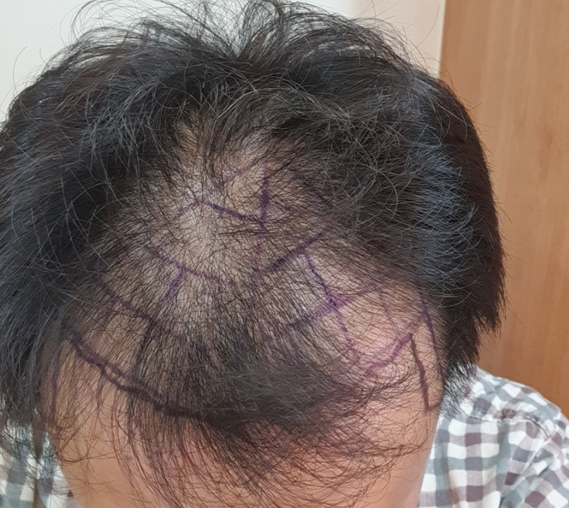 절개 2200모낭, 수술 1년차 후기 입니다