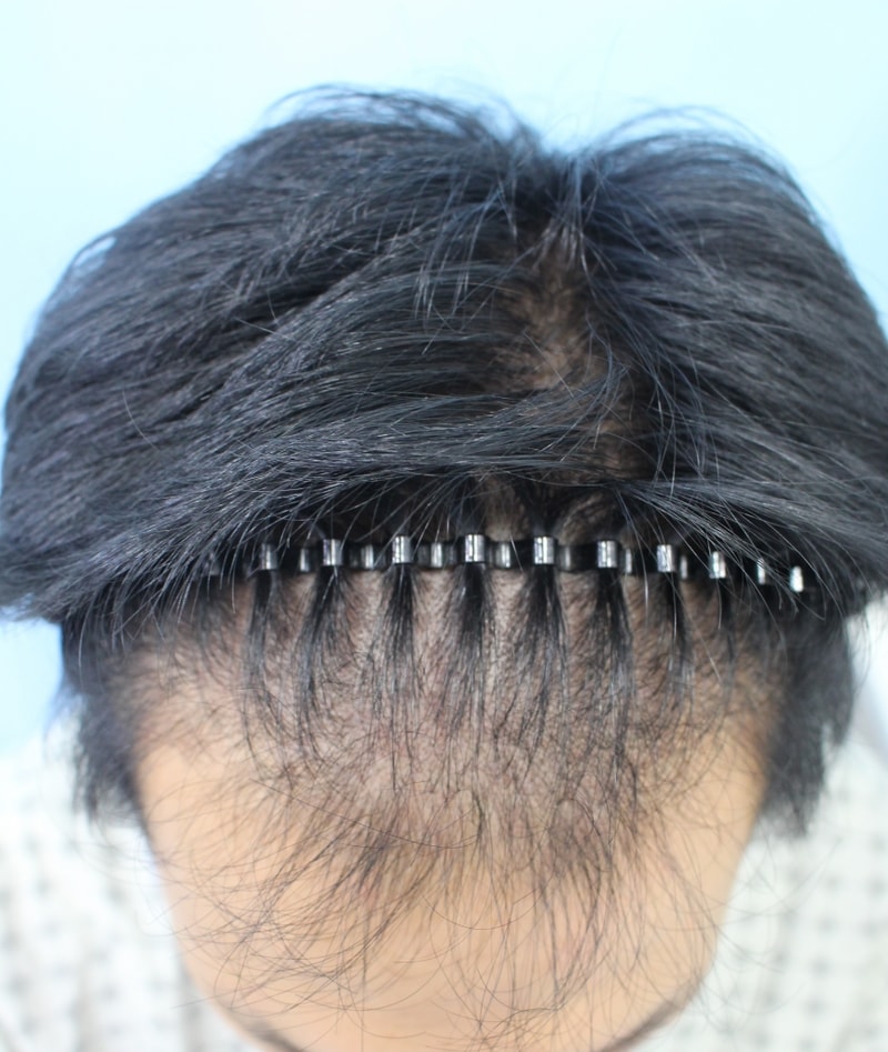 1년 경과 사진