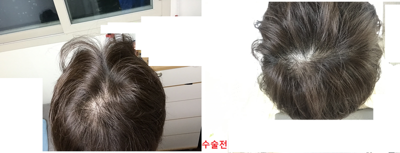 수술전.png