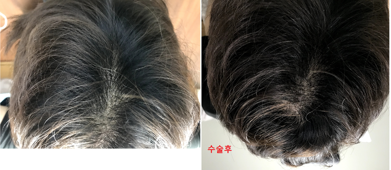 수술후.png