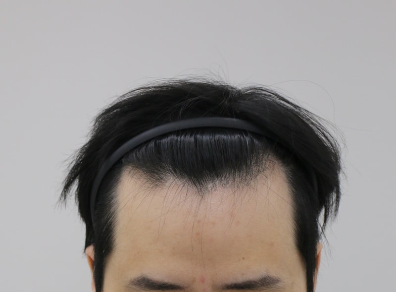 포헤어 8개월 간단후기