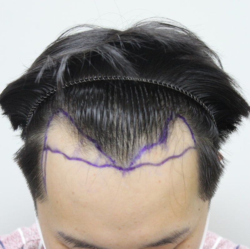수술전1.jpg