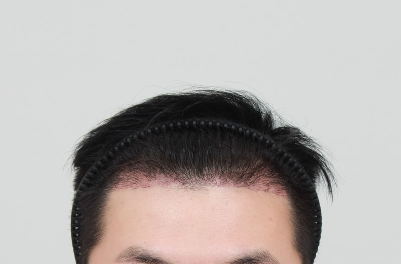 수술3주후.jpg