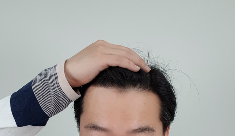 비절개 슬릿 7개월 밀도 괜찮나요?