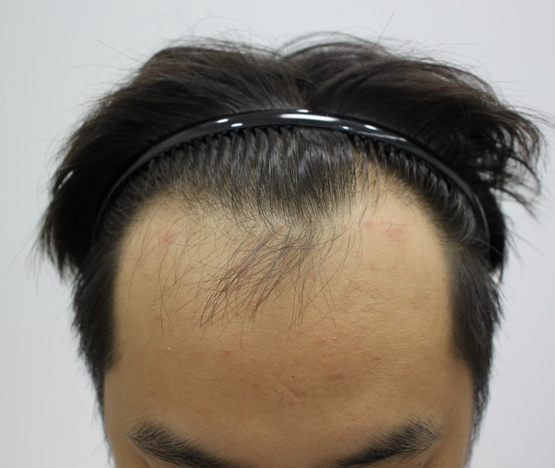 before / after 경과 수술전~ 7개월 최종경과