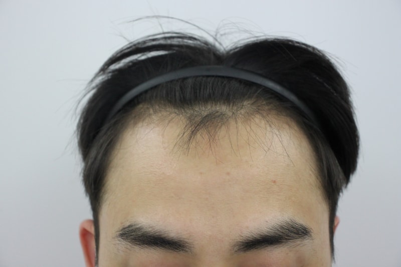모발이식 전 부터 ~ 8개월 과정 결과