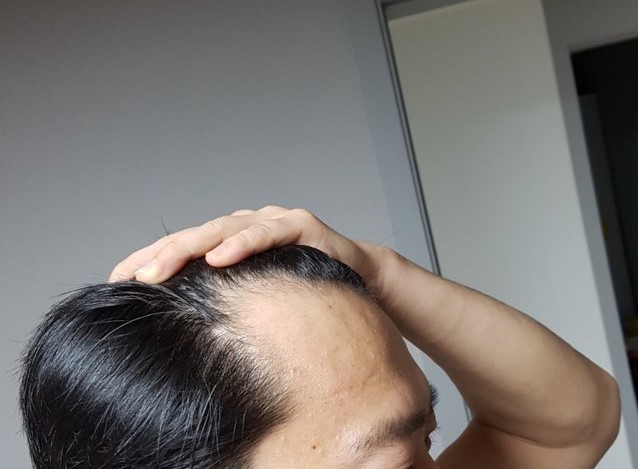 수술전 오른쪽.jpg
