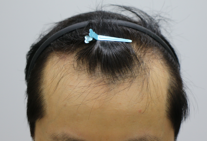 I had a hair transplant in Apgujeong Forehead.