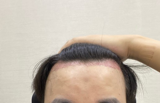 8개월 비절개모발이식 마무리 경과