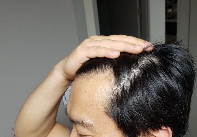 수술전 왼쪽.jpg