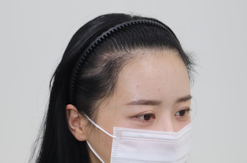 수술4개월11.jpg