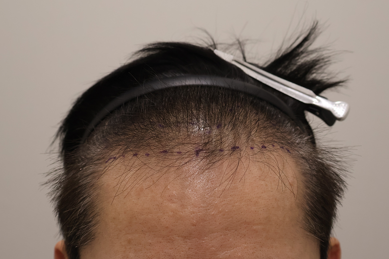 Incheon Maimo Clinic's 1200 hair follicles after 3 months