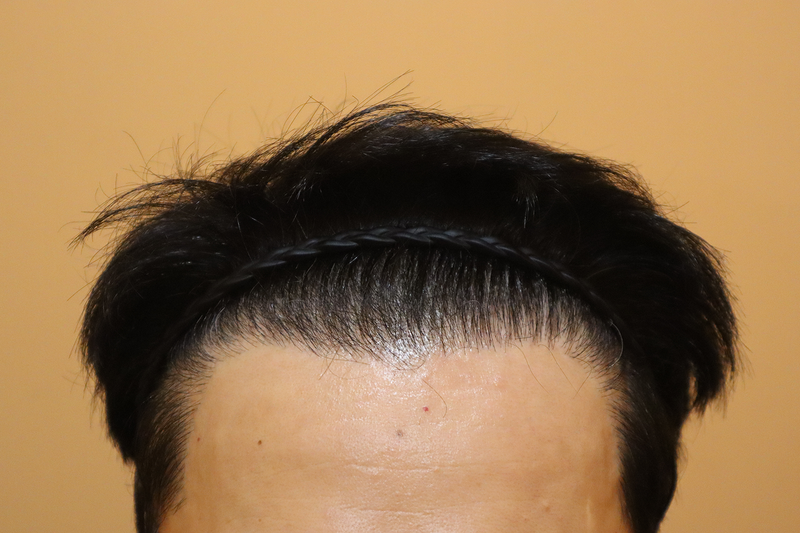 HAIRO HAIR TRANSPLANT CENTER Busan Hairline Density Reinforcement after 2 weeks of hair follicles
