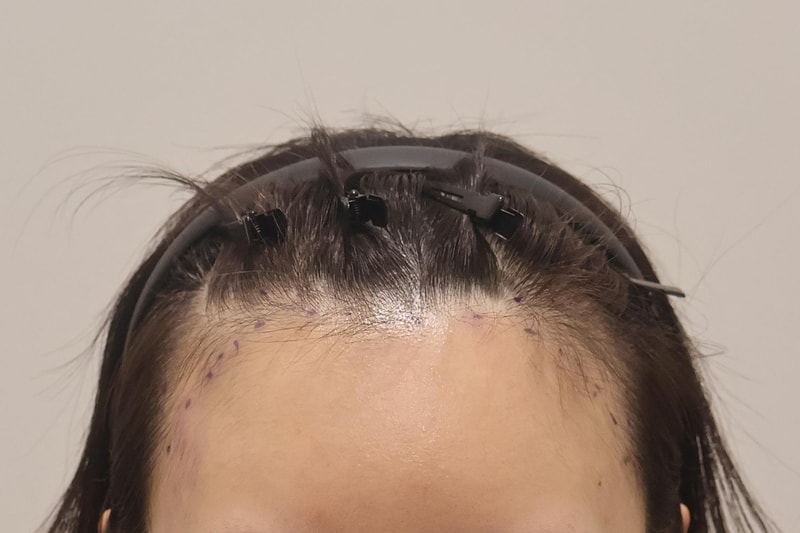 A month has passed since Incheon Maimo Clinic 800 hair follicles