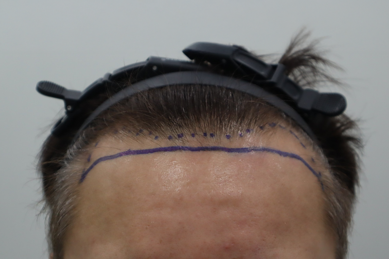 2400 non-cut hair transplant with Jeonju hair, about 2 weeks