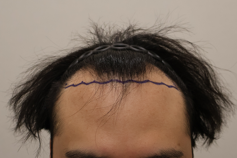 Dongtan Hair Clinic's 3,400-mo surgery review immediately after surgery