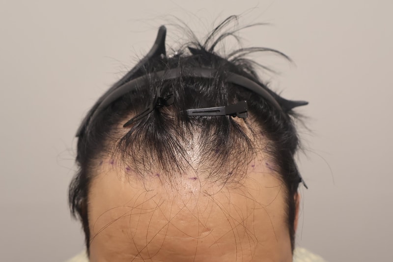 인천 마이모 비절개로 1800모 이식한지 두달 됐습니다