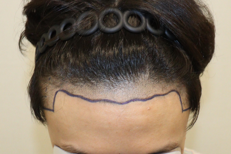 HAIRO HAIR TRANSPLANT CENTER Daegu Non-cutaneous 2000 Mo 2 Weeks and Late Periods