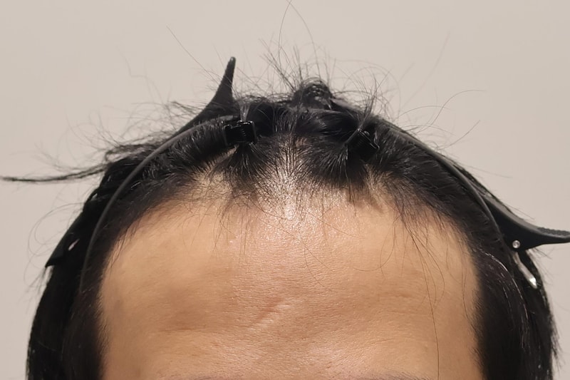 인천 마이모의원 비절개 모발이식 1600모낭 3개월차 후기입니다
