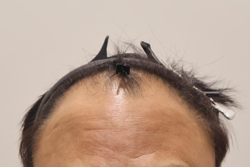 인천마이모의원 비절개모발이식 1000모낭 6개월 경과