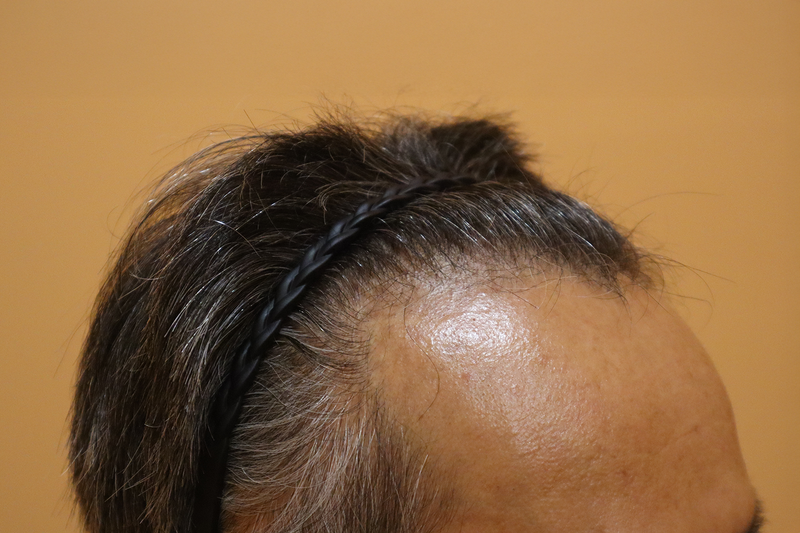 I went to HAIRO HAIR TRANSPLANT CENTER Busan for 2 weeks after non-cut hair transplant 1,600 hair follicles.
