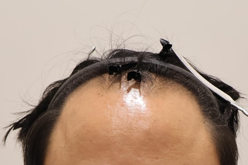 인천마이모 비절개 3000모 3개월 경과 보고왔습니다.