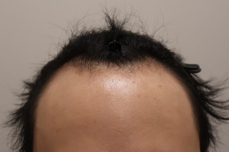 Busan Hair Orphan Clinic Non-Cutting Hair Transplantation 1300 Hair Orphanage 2 Weeks Late