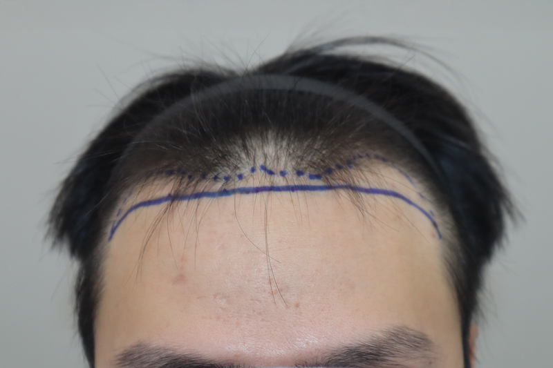 全州ヘアロ医院のビジョルゲ2700本入り、2週間になりました