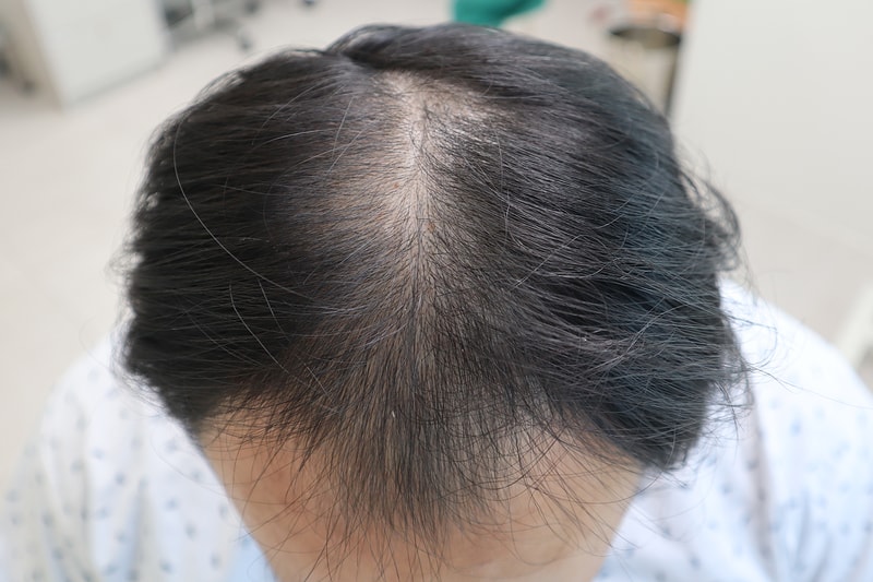 부산헤어로 5600모 비절개 모발이식 9개월 후기