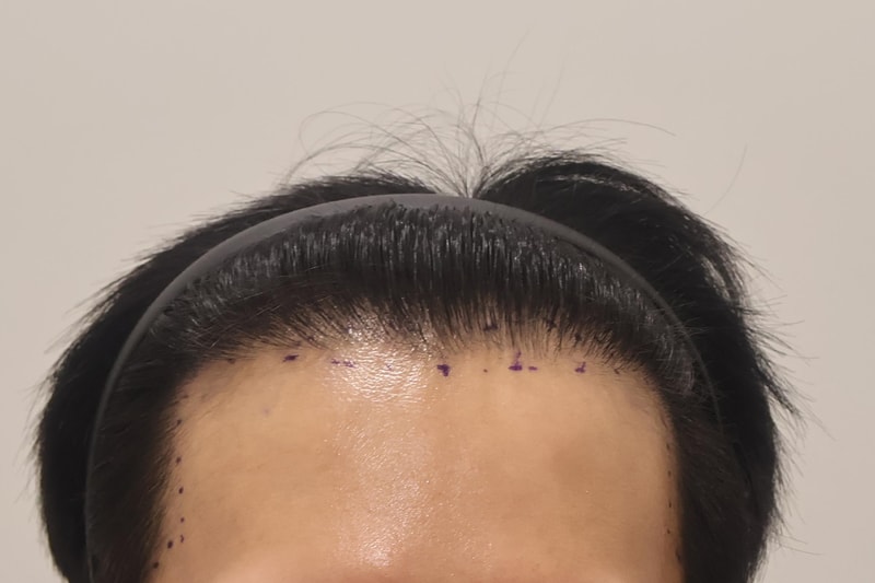 인천 마이모 비절개 모발이식 600모 2주 경과 후기입니다