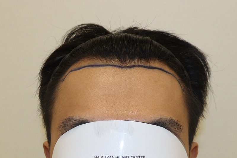 Daegu Hairrow Clinic's Non-Cutting No Cut 2200 Mo 2 Weeks Later Review