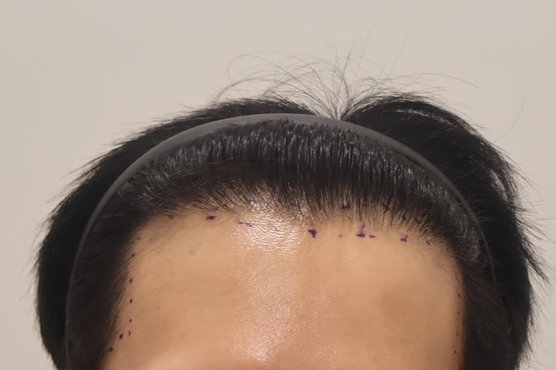 인천 마이모 비절개 모발이식 600모 3달 후기입니다